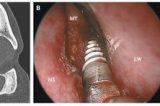 Médicos descobrem dente implantado no nariz de mulher