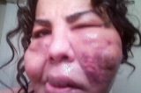 Após deformação, travesti comemora grande número de pretendentes