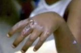 Mãe queima mãos de filhas de 6 e 10 anos com colher quente como castigo