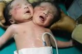 Vídeo: Nasce bebê com duas cabeças na Índia