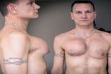 Cirurgia errado e homem fica com ‘seio’ Cirurgia errado e homem fica com ‘seio’