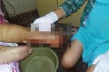 Descaso na saúde em Petrolina: dona de casa sofre com pé apodrecendo numa cadeira de roda