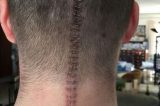 Homem reage com humor a cirurgia para retirar tumor no cérebro
