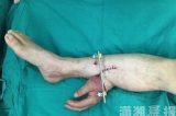 Mão decepada em acidente é implantada em perna de paciente