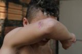 Menor que sobreviveu a linchamento mostra ferimentos e diz que foi reconhecido por vizinho