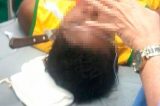Por ciúmes, mulher crava faca na cabeça de rival