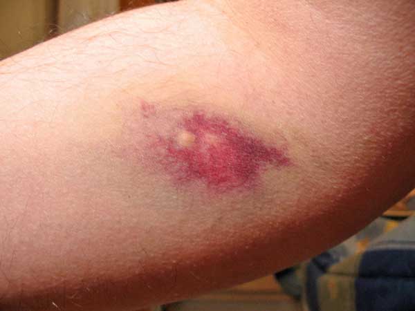 hematoma