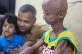 Garoto de 14 anos envelhecer 8x mais rápido que o normal