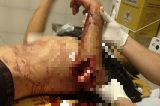 Homem tem braços e pernas dilacerado após explosão de caixa eletrônico