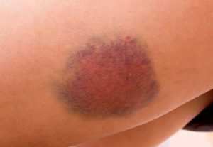 hematoma em mulher