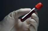 ANS determina que planos cubram teste para varíola dos macacos