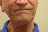 A emoção de pacientes que tiveram câncer de laringe e voltam a falar após implante de prótese