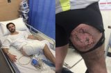 iPhone 6 explode no bolso de ciclista e causa queimaduras graves