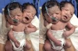 Bebê com duas cabeças nasce no México