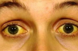 Com sintomas parecidos, febre amarela pode ser confundida com gripe; saiba diferenças Com sintomas parecidos, febre amarela pode ser confundida com gripe; saiba diferenças
