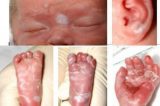 Sífilis avança em bebês no Brasil e contraria metas da Unicef