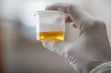 O excêntrico mercado de venda de urina em meio a epidemia de drogas nos EUA