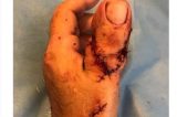 Homem tem dedo do pé implantado na mão. Imagens fortes Homem tem dedo do pé implantado na mão. Imagens fortes