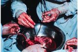 De testes com cães a ‘medo de deixar cair’, as histórias por trás do 1º transplante de coração no Brasil De testes com cães a ‘medo de deixar cair’, as histórias por trás do 1º transplante de coração no Brasil