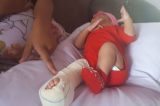 Ipiaú: Bebê sofre fratura no fêmur após cesárea; hospital alega ‘parto difícil’