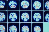 Uma caçada em busca dos primeiros sinais do mal de Alzheimer