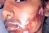 Mulher sofre queimaduras graves no rosto após fazer depilação a laser