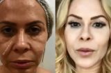 Joelma mostra antes e depois da harmonização facial
