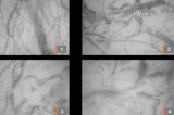 Pesquisadores registram ao vivo formação de coágulos em vasos sanguíneos de pacientes