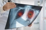 Pacientes mortos pela Covid-19 desenvolveram fibrose pulmonar