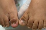 Menina de 2 anos chegou a hospital sem unhas e com lesões no intestino, em GO