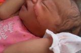 Bebê leva treze pontos após ter rosto cortado em cesárea de emergência