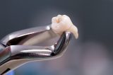 Morte de mulher após extração de dente na Bahia acende alerta; saiba quando há riscos