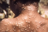 Ministério da Saúde confirma 9º caso de varíola dos macacos no país