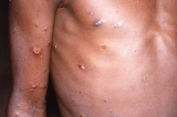 OMS: varíola dos macacos não é uma emergência de saúde no momento