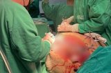 Mulher que teve tumor de 46 kg removido morre 11 dias após cirurgia Mulher que teve tumor de 46 kg removido morre 11 dias após cirurgia