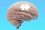 Lecanemab: medicamento experimental contra Alzheimer tem resultados ‘históricos’