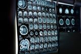 Cérebros de pessoas obesas têm prejuízos parecidos com os de quem tem Alzheimer