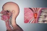 Câncer na garganta: por que sexo oral pode ser fator de risco?