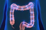 Colite microscópica, a doença intestinal de difícil diagnóstico que atinge mais as mulheres