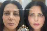 Sônia Lima mostra o antes e o depois de harmonização facial