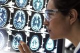 Cientistas podem ter desvendado enigma de como Alzheimer ‘mata’ neurônios
