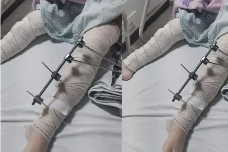 Médicos colocam pinos em perna errada de menina de 6 anos na Paraíba