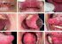 Vape: uso do produto por apenas 12 meses deixa mulher de 22 anos com úlceras dolorosas na boca