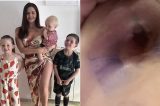 Mulher faz cirurgia de silicone, mas procedimento dá errado e seios ficam pretos e vazando