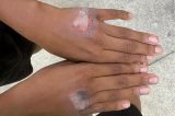 Mulher suspeita de queimar as mãos do próprio filho com chapinha de cabelo em Olinda