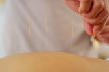 Acupuntura causa dor? Especialista responde