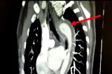 Mulher rompe aorta durante relação sexual e é levada às pressas para cirurgia