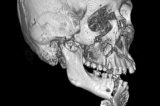 Aumento de reconstruções de face após acidentes de moto preocupa profissionais do Hospital da Restauração Aumento de reconstruções de face após acidentes de moto preocupa profissionais do Hospital da Restauração