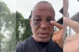 Wanderlei Silva revela sequelas de agressão e afirma que irá à Justiça