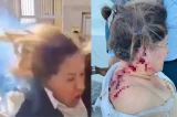 Deputada é atingida na cabeça por explosivo e fica gravemente ferida